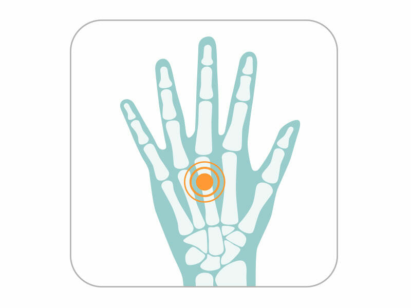 Ergonomic pipettes: Graphic of a hand, orange spot on palm to indicate hand pain from pipetting
